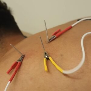 Neuromodulación Percutánea (Electroacupuntura Terapéutica) por Zona | La Fisio